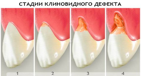 клиновидный дефект зуба