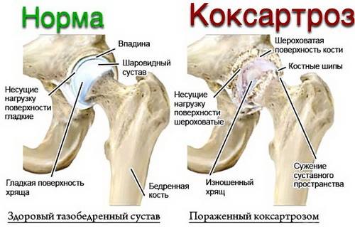 УЗИ тазобедренного сустава