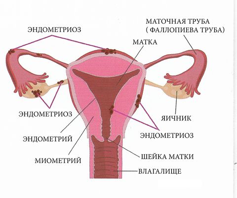 endometrioz1