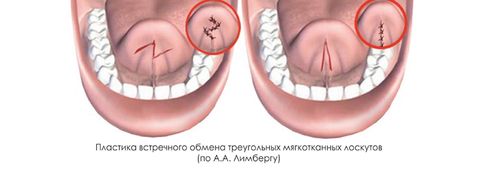 пластика уздечки языка