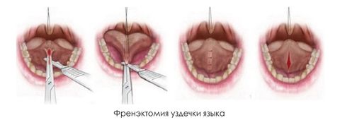 пластика уздечки языка