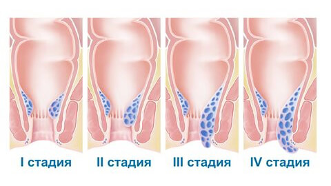 Склерозирование геморроидального узла