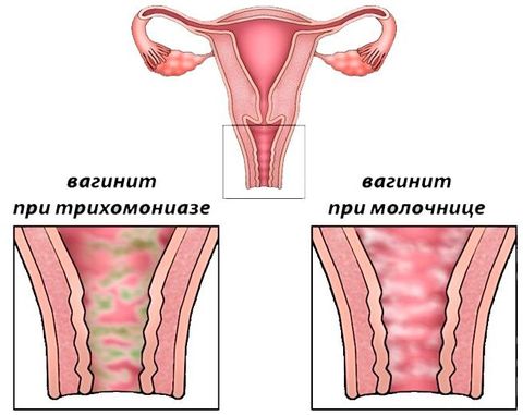 вагинит