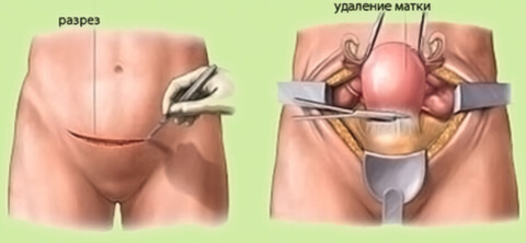 Экстирпация матки Экстирпация матки