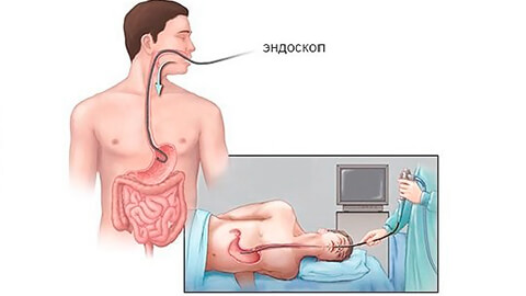 Кто делал гастроскопию во сне. gastroskopiya vo sne 2. Кто делал гастроскопию во сне фото. Кто делал гастроскопию во сне-gastroskopiya vo sne 2. картинка Кто делал гастроскопию во сне. картинка gastroskopiya vo sne 2. Гастроскопия — метод эндоскопического исследования пищевода, желудка и двенадцатиперстной кишки. Наряду со многими другими видами эндоскопии, этот вид исследования причиняет пациенту дискомфортные ощущения, поэтому в современной медицинской практике гастроскопия все чаще проводится под наркозом.