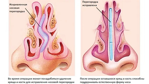 Септопластика