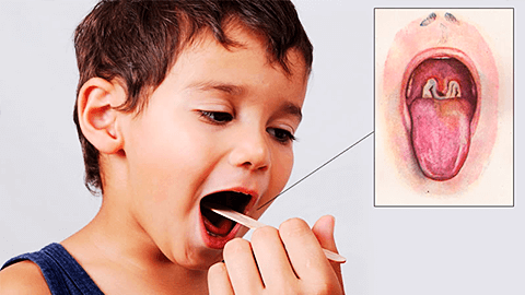 Круп стеноз гортани и трахеи у детей: симптомы и лечение