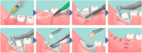 Удаление зуба мудрости