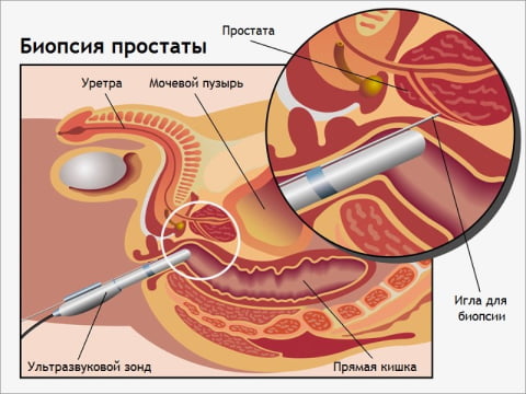 Биопсия предстательной железы