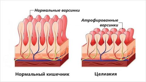 Анализ крови на глютен Анализ крови на глютен