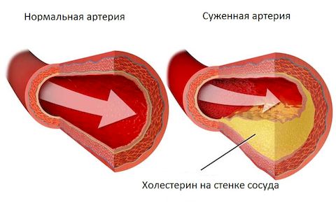 Анализ крови на холестерин 