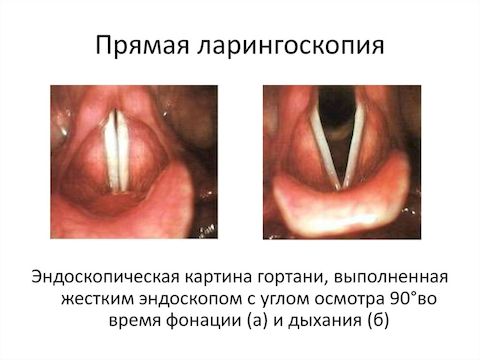 Ларингоскопия Ларингоскопия