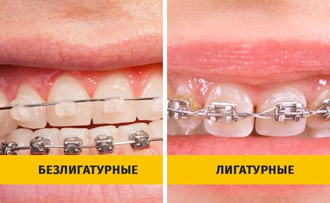 Металлические брекеты Металлические брекеты