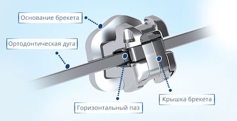 Металлические брекеты Металлические брекеты