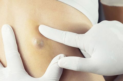 Удаление атеромы Удаление атеромы
