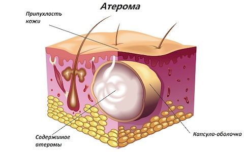 Удаление атеромы 