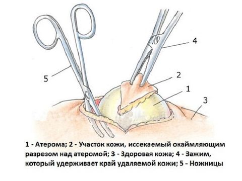 Удаление атеромы 