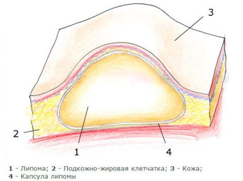 Удаление липомы Удаление липомы
