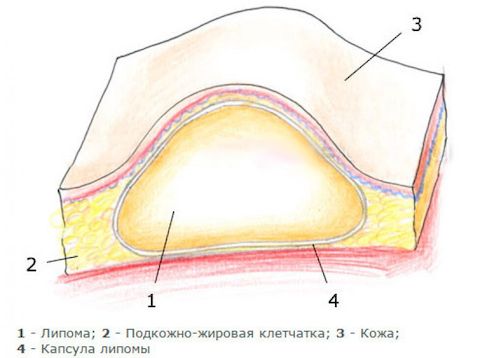 Удаление липомы 