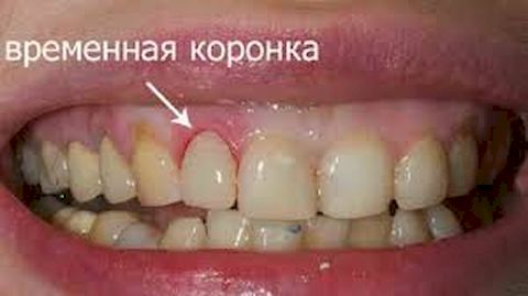 временные коронки временные коронки