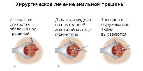 Процедура иссечения анальных трещин