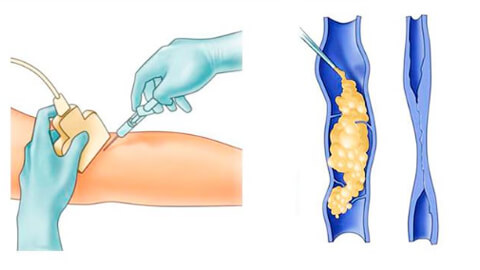 Склерозирование вен