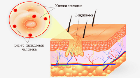Удаление кондилом вульвы и влагалища