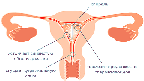 Действие внутриматочной спирали Мирена