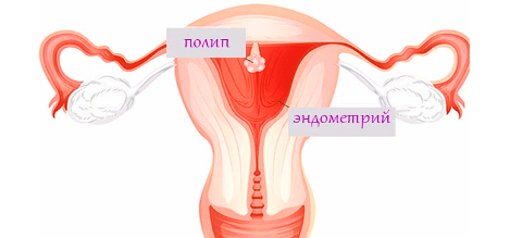 Удаление полипа матки