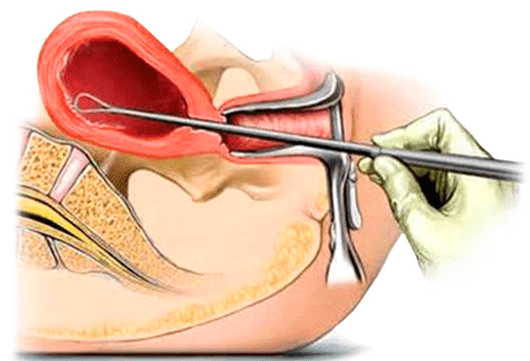 Операция по удалению полипа матки