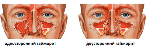 Пункция при гайморите