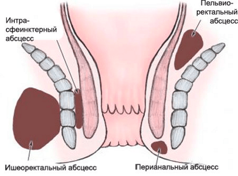 Вскрытие парапроктита