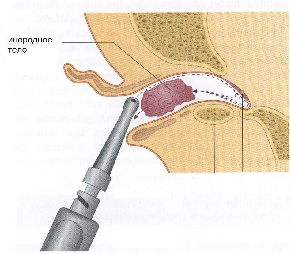 Проведение удаления инородного тела из уха