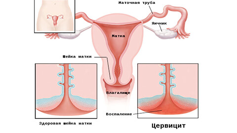 цервицит