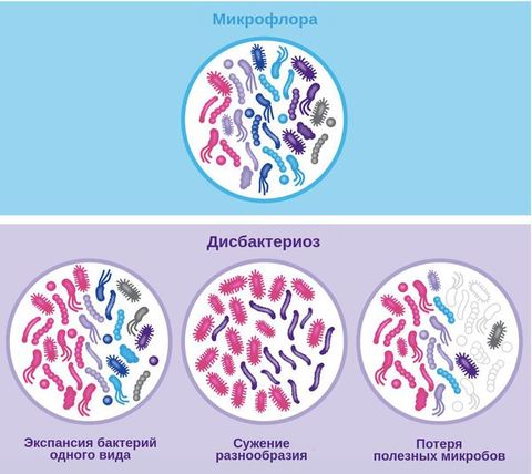 Дисбактериоз 