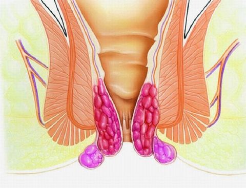 геморройидальные узлы