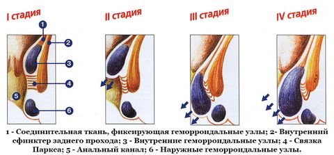 геморройидальные узлы