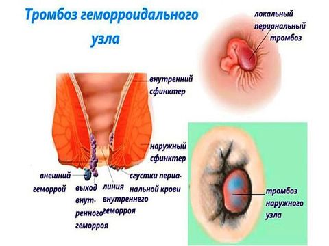 геморройидальные узлы