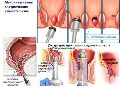 геморройидальные узлы