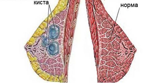 киста молочной железы