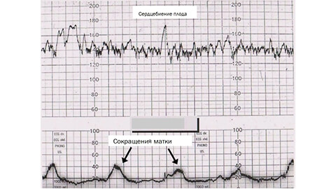КТГ плода