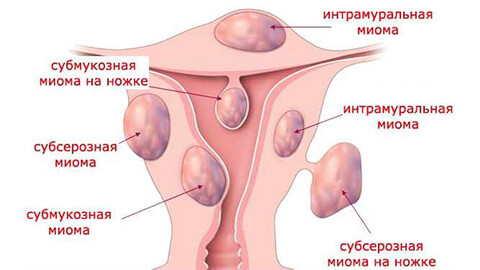 миома матки