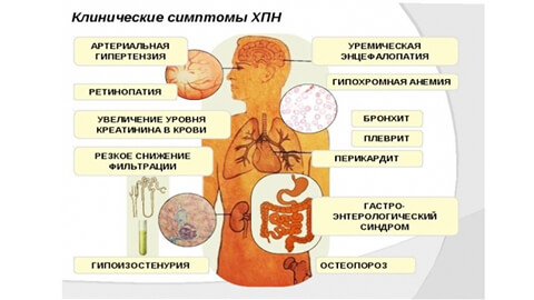 почечная недостаточность