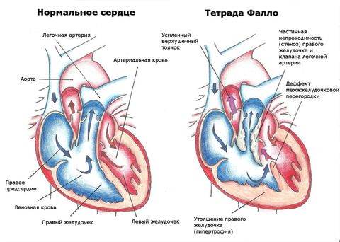 порок сердца