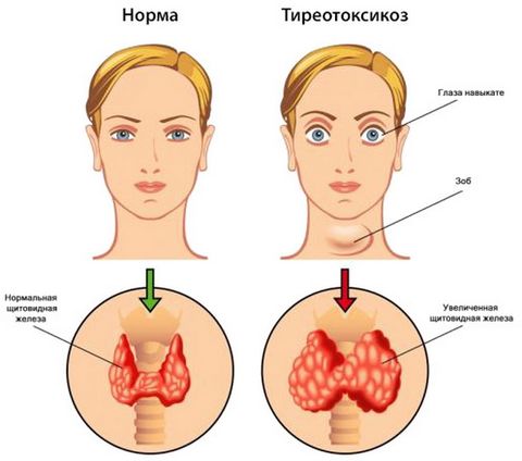 Щитовидная железа описание и симптомы thumbnail