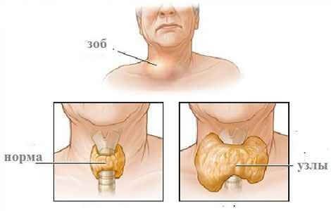 Симптомы заболевания щитовидной железы у человека thumbnail