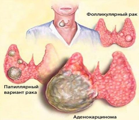 Щитовидная железа у мужчин или женщин thumbnail