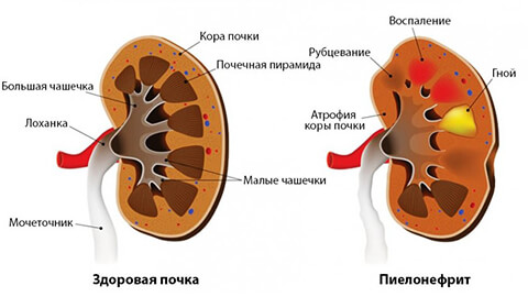 Воспаление почек