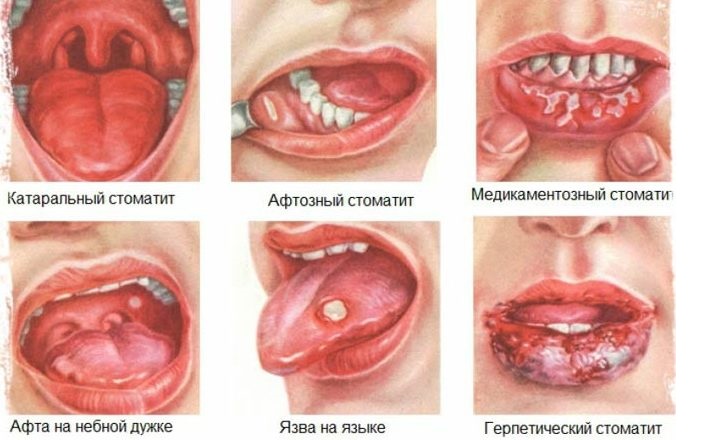 Лечат ли прополисом стоматит