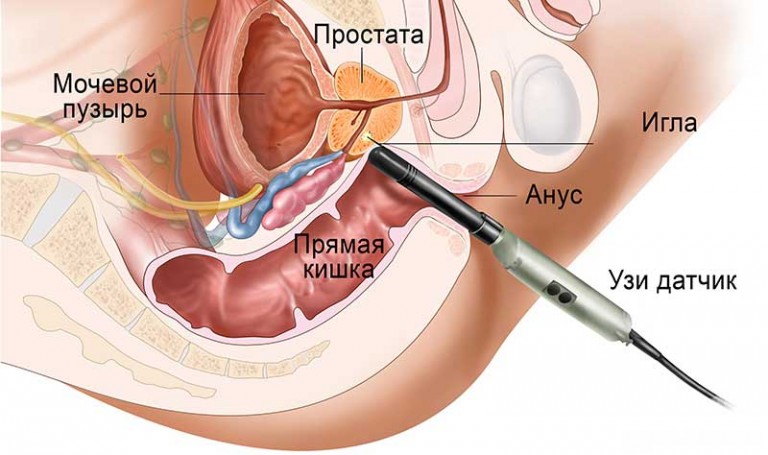 ТрУЗИ предстательной железы